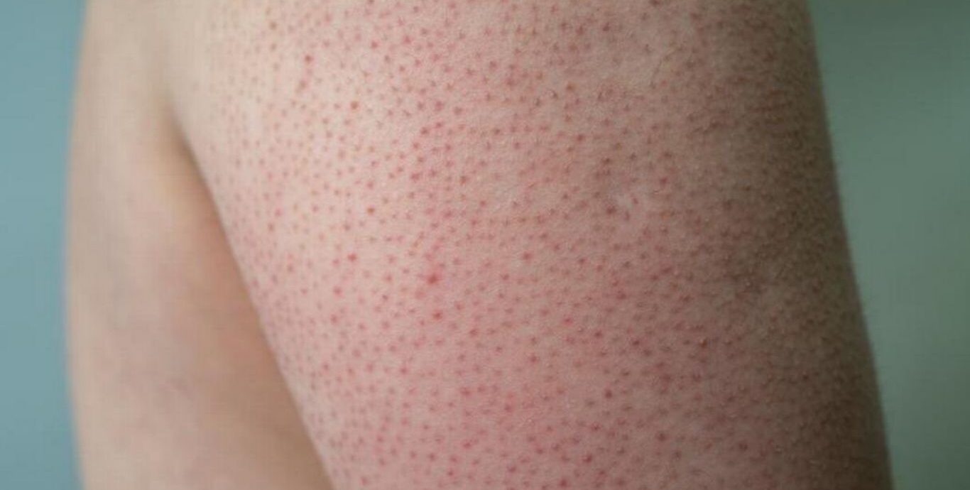 keratosis pilaris
