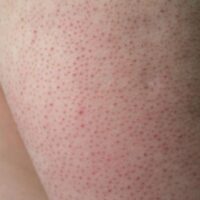 keratosis pilaris