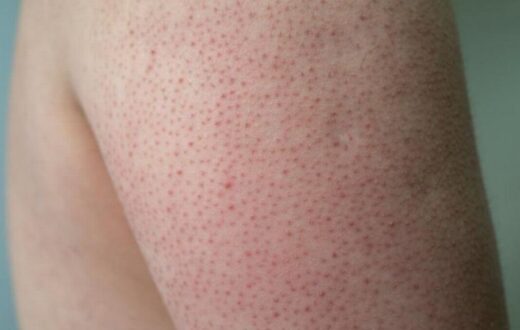 keratosis pilaris