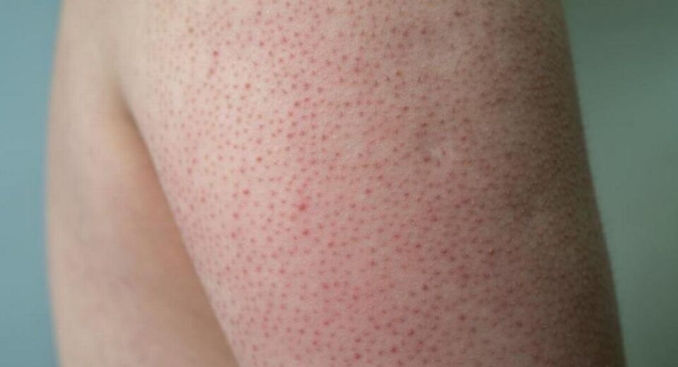 keratosis pilaris