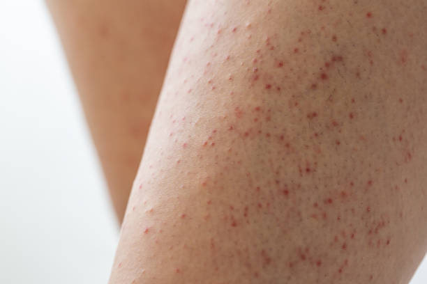 Keratosis pilaris benen
